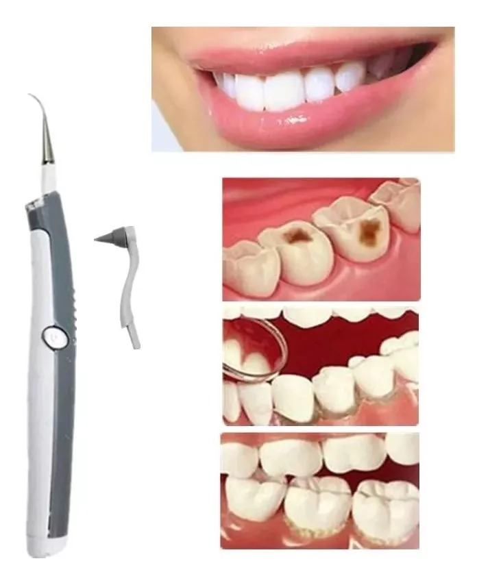 Blanqueador Dental Blancamiento Ultra Sónico Limpieza Dental